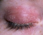 Аллергический дерматит век код мкб thumbnail