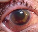 Клиники лечения туберкулез глаза thumbnail