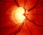 H53 Расстройства зрения