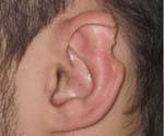 M95.1 Деформация ушной раковины, вызванная травмой и последующим перихондритом