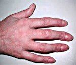 Артрозо артрит межфаланговых суставов кистей рук мкб thumbnail