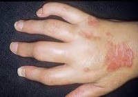 Ревматоидный артрит и другие полиартропатии мкб 10 thumbnail