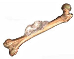 Новообразования костей код мкб thumbnail