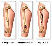Код диагноза при переломе ноги thumbnail