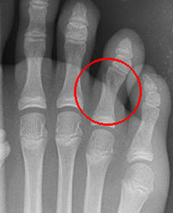 Перелом пальца левой ноги мкб thumbnail