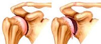 Артроз артрит плечевого сустава мкб 10 thumbnail