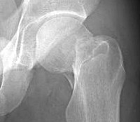 Перелом шейки бедра на фоне остеопороза код по мкб 10 thumbnail
