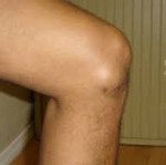 Бурсит коленного сустава лечение мкб 10 thumbnail