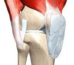 Код мкб эндопротезирование коленного сустава thumbnail