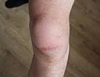 Мкб гематома коленного сустава