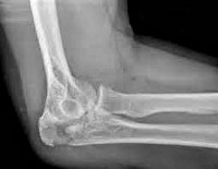 Диагноз перелом нижнего конца лучевой кости thumbnail