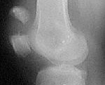 Перелом левого коленного сустава код по мкб 10 thumbnail