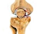 Посттравматический артроз правого коленного сустава мкб 10 thumbnail