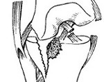 Переломы дистального отдела большеберцовой кости thumbnail