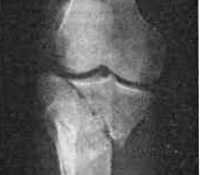 Перелом мыщелка коленного сустава код мкб thumbnail