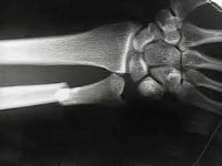 Перелом шиловидного отростка локтевой кости мкб