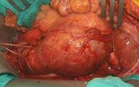 Аневризма аорты брюшной полости код мкб thumbnail