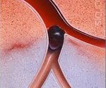 Острый тромбоз подвздошной артерии код по мкб thumbnail