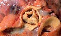 Врожденный стеноз аортального клапана код по мкб 10 thumbnail