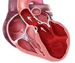 Дилатационная кардиомиопатия мкб код thumbnail