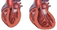 Вторичная кардиопатия мкб код thumbnail