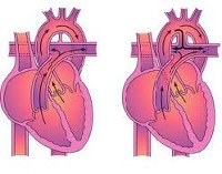 Код по мкб врожденный порок сердца открытый артериальный проток thumbnail