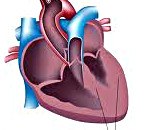 Вторичная дилатационная кардиомиопатия код мкб thumbnail