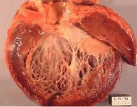 Дилатационная кардиомиопатия код мкб thumbnail