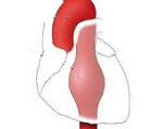 Аневризма грудной аорты код мкб thumbnail