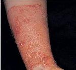 Простой раздражительный контактный дерматит по мкб 10 thumbnail