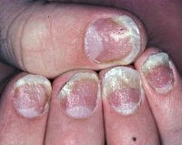 Дистрофические изменения ногтевой пластины код мкб thumbnail