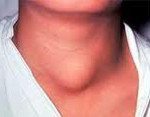 Диффузное увеличение щитовидной железы код мкб thumbnail