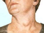 Код мкб узел щитовидной железы thumbnail
