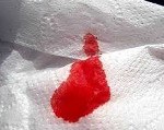 Прямокишечное кровотечение код мкб thumbnail