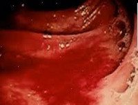 Код мкб желудочно кишечное кровотечение неуточненное thumbnail