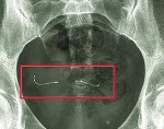 Инородное тело в желудочно кишечном тракте код мкб 10 thumbnail