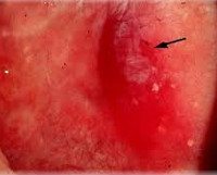 Эритроплакия шейки матки мкб 10 код thumbnail