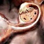 Синдром преждевременного истощения яичников мкб thumbnail