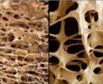 Код мкб постменопаузальный остеопороз thumbnail