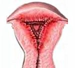Эндометрит после родов код мкб thumbnail