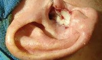 Новообразование ушной раковины код мкб thumbnail