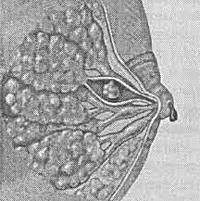 Внутрипротоковая папиллома молочной железы