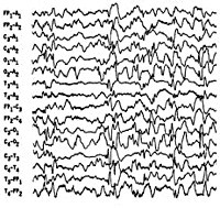 Эпилептиформный синдром код по мкб 10 thumbnail