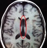 Гипоплазия мозга код по мкб 10 thumbnail