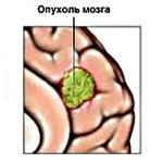Астроцитома головного мозга код мкб thumbnail