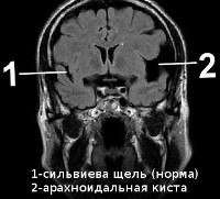 Киста прозрачной перегородки головного мозга код мкб thumbnail