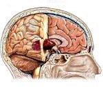Злокачественное новообразование головного мозга код мкб thumbnail