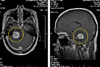 Доброкачественная опухоль мозга код мкб thumbnail