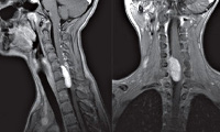 Болезнь спинного мозга мкб кода thumbnail