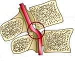 Синдром позвоночной артерий по мкб thumbnail